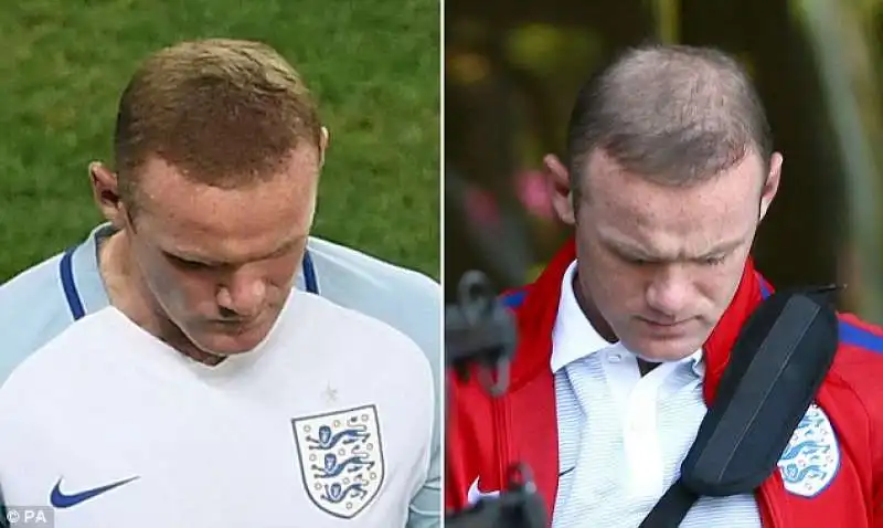  wayne rooney trapianto di capelli