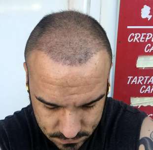 TRAPIANTO DI CAPELLI IN TURCHIA