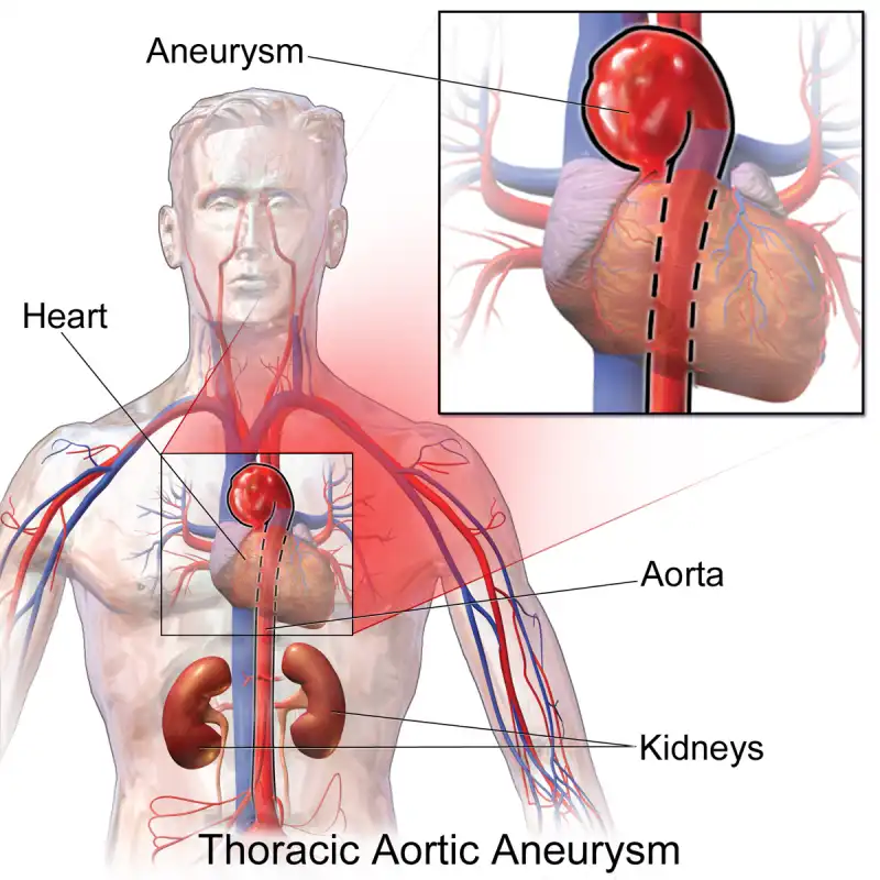 aneurisma  dell aorta