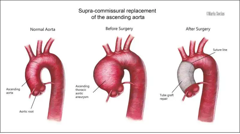 aneurisma dell aorta