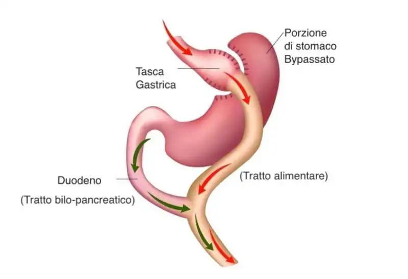 bypass gastrico