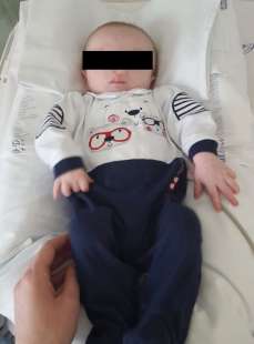 IL BAMBINO A CUI SCENDEVA IL CERVELLO NEL NASO, SALVATO A TORINO