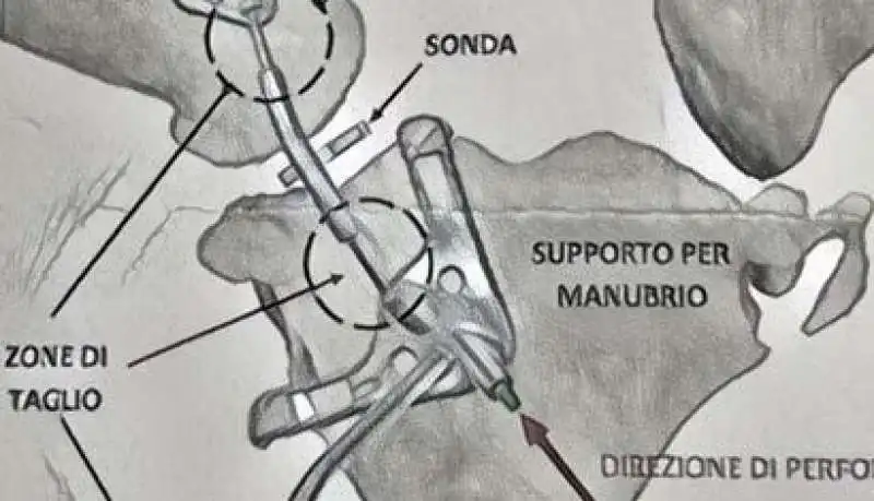 CLAVICOLA RICOSTRUITA CON STAMPANTE IN 3D