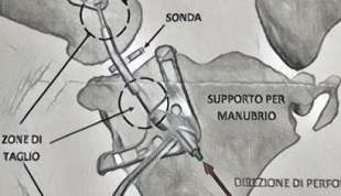 CLAVICOLA RICOSTRUITA CON STAMPANTE IN 3D