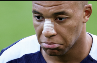 mbappe' con il naso rotto