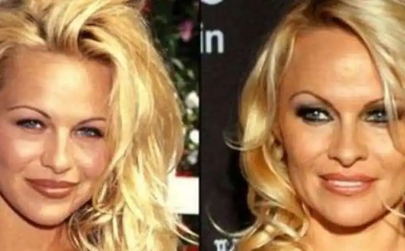 pamela anderson prima e dopo