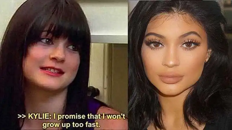 kylie jenner prima e dopo il chirurgo  4