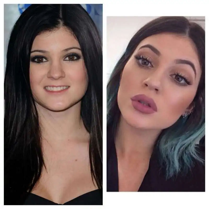 kylie jenner prima e dopo il chirurgo  5