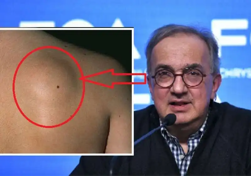 Sarcoma - Marchionne