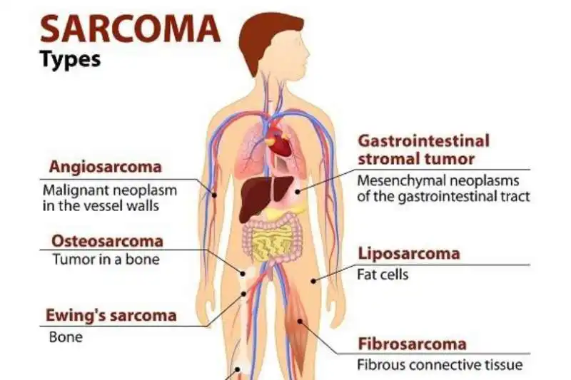 Sarcoma 