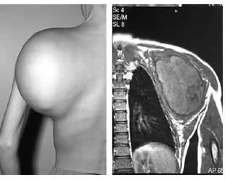 sarcoma di ewing