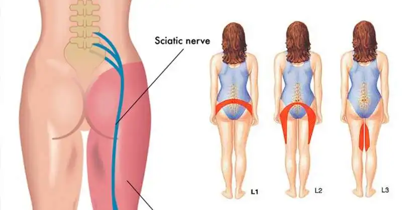 SCIATICA 