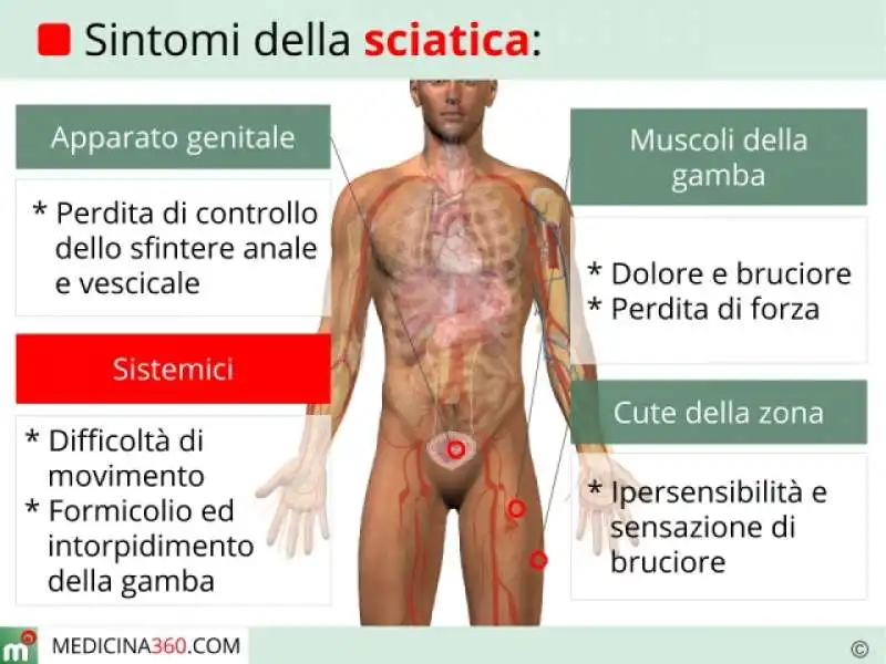 SCIATICA 