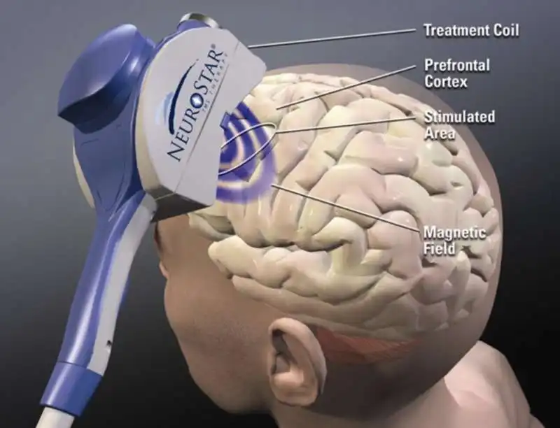 STIMOLAZIONE MAGNETICA TRANSCRANICA 1
