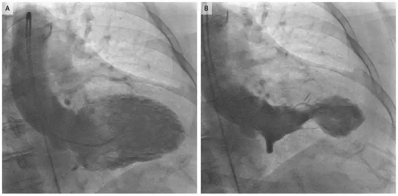 sindrome di tako tsubo o del cuore infranto  1