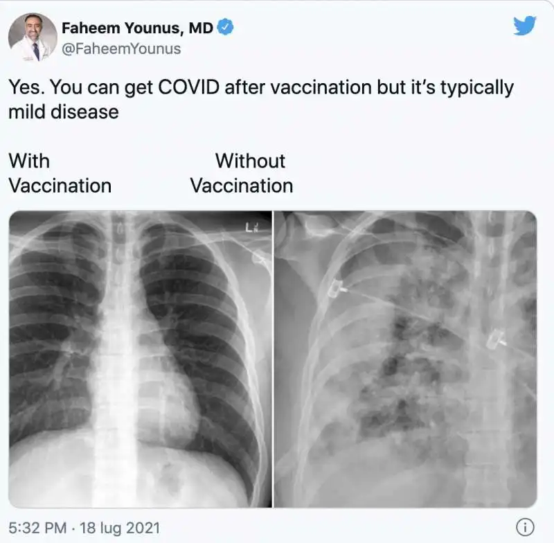 il tweet del dottor faheem younus   polmoni di un vaccinato vs polmoni di un non vaccinato