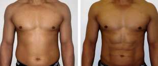 liposcultura addominale