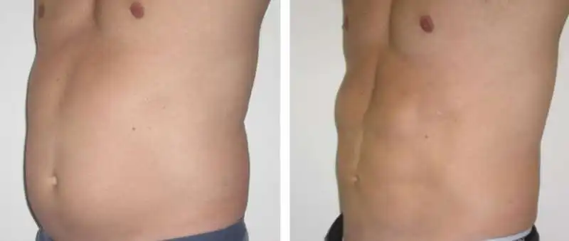 liposcultura addominale 