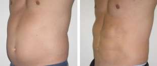 liposcultura addominale