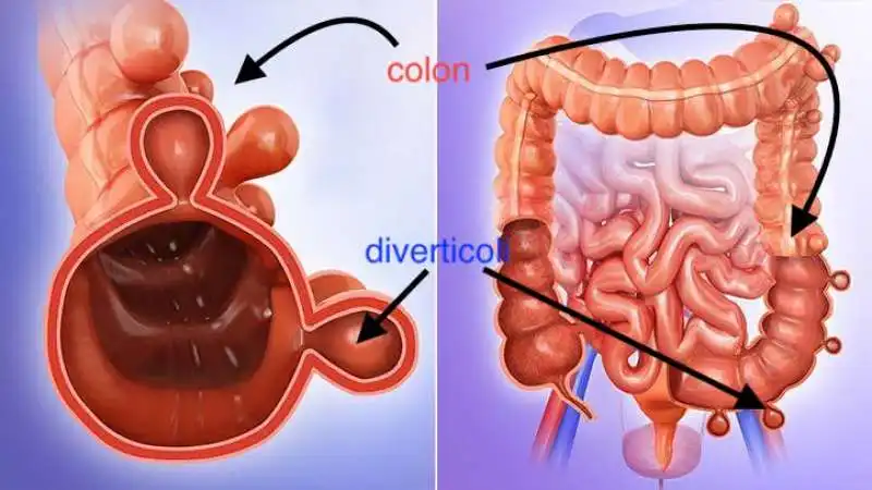 stenosi diverticolare