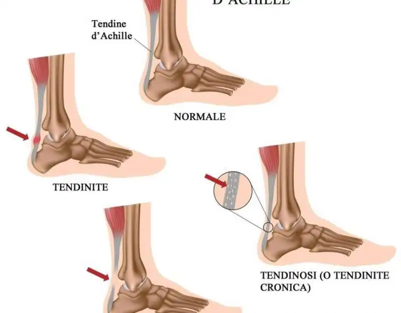 tendine d achille