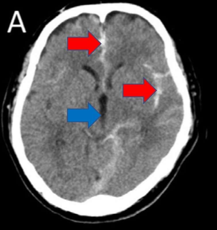 Una radiografia del cervello con emorragia