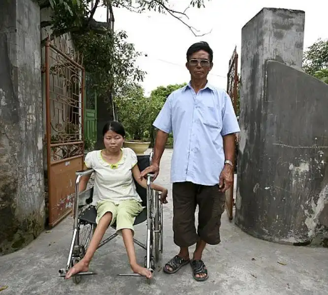 BAMBINI VITTIME AGENTE ORANGE IN VIETNAM 