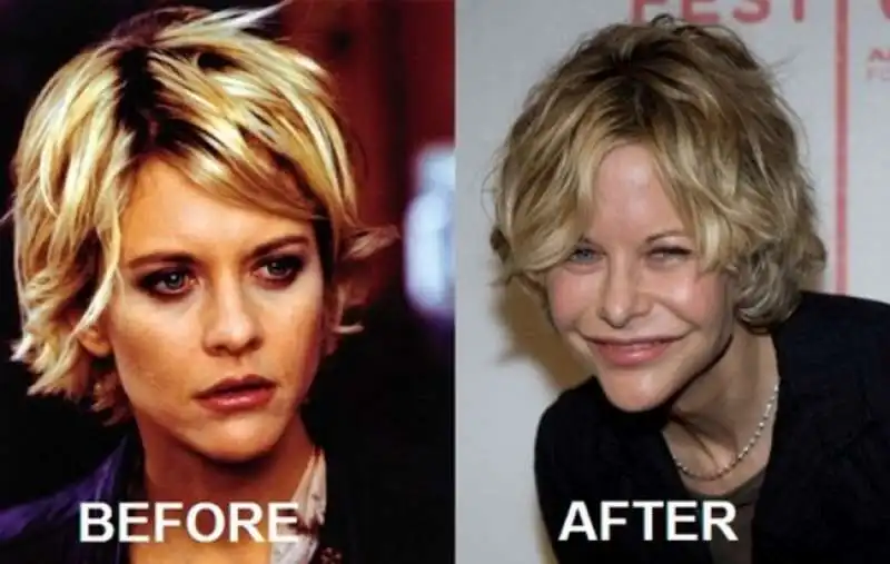 meg ryan troppa plastica  