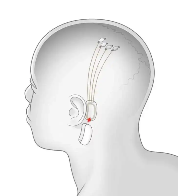 neuralink 1