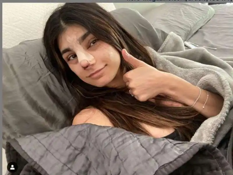 mia khalifa rinoplastica