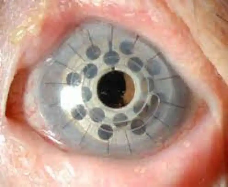 cornea artificiale  2