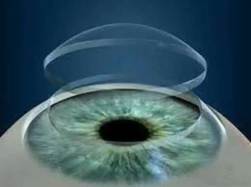 cornea artificiale 5