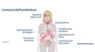 AMILOIDOSI