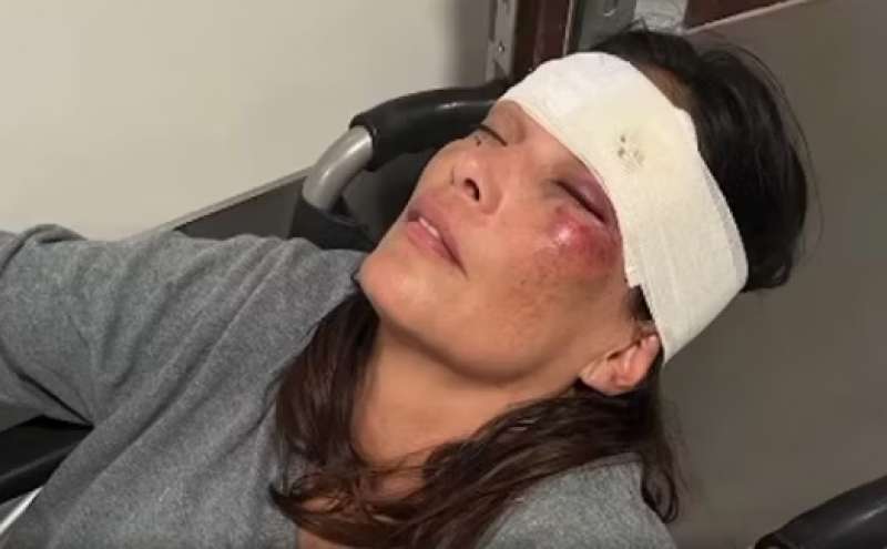 fernanda lessa con il volto tumefatto dopo l incidente 1