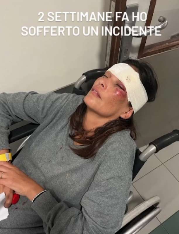 fernanda lessa con il volto tumefatto dopo l incidente 12