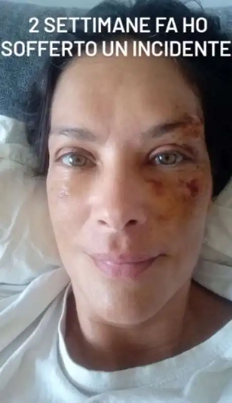 fernanda lessa con il volto tumefatto dopo l incidente   5