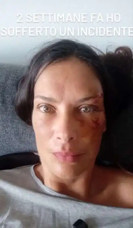 fernanda lessa con il volto tumefatto dopo l incidente   7