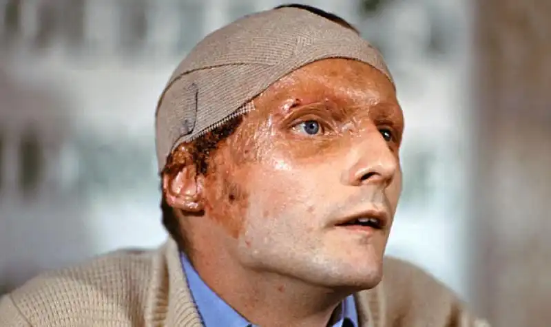 NIKI LAUDA DOPO L INCIDENTE 