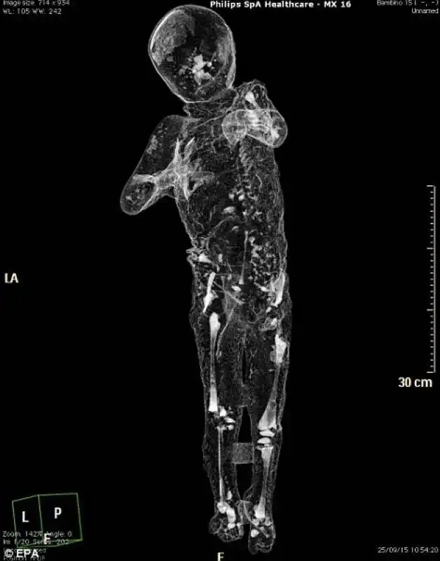 scanner di un bambino di 4 anni   pompei