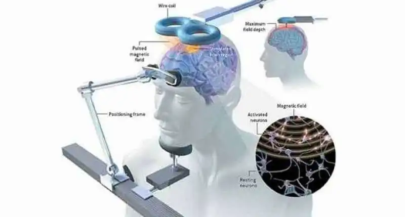 stimolazione magnetica transcranica