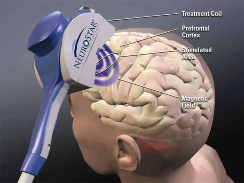 stimolazione magnetica transcranica 4