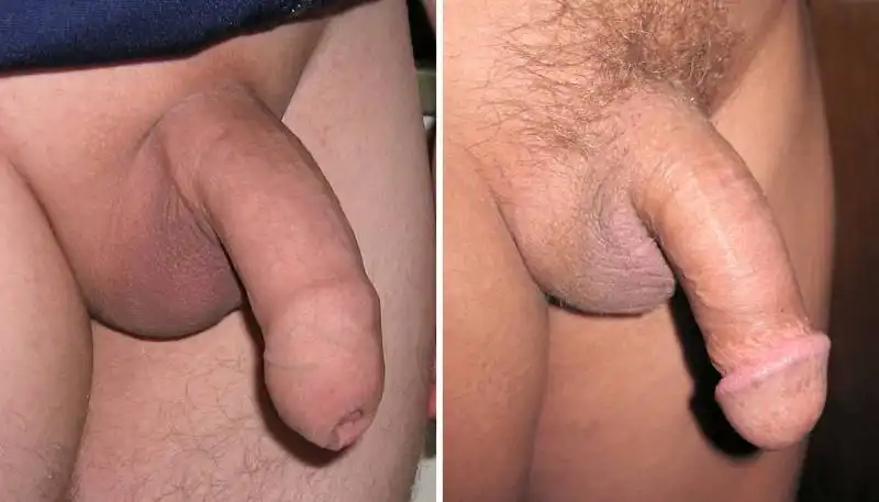 a destra un pene circonciso