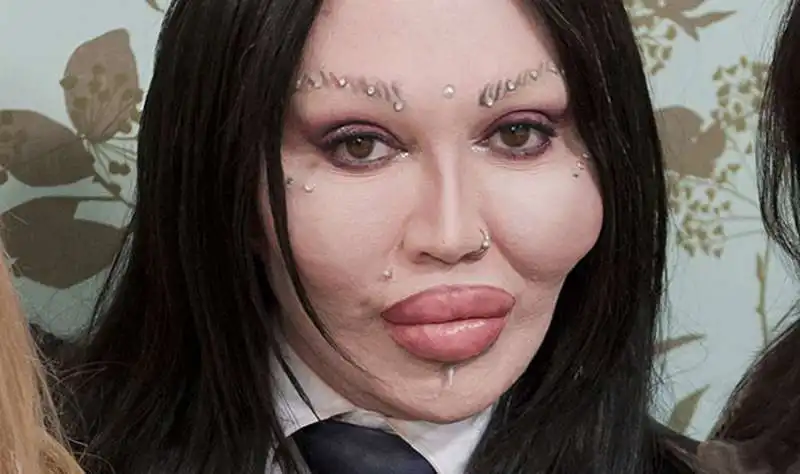 pete burns chirurgia