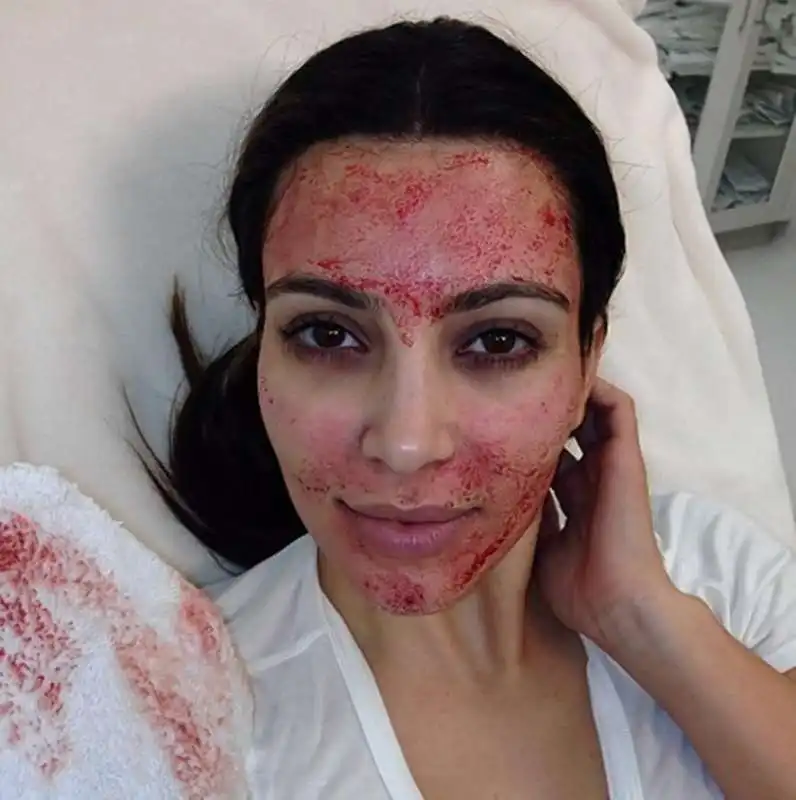 KIM KARDASHIAN VAMPIRE FACIAL