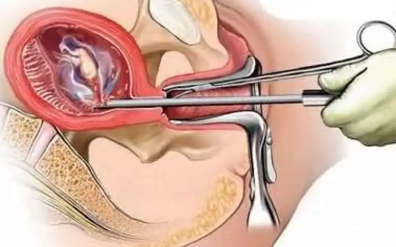 raschiamento uterino 4