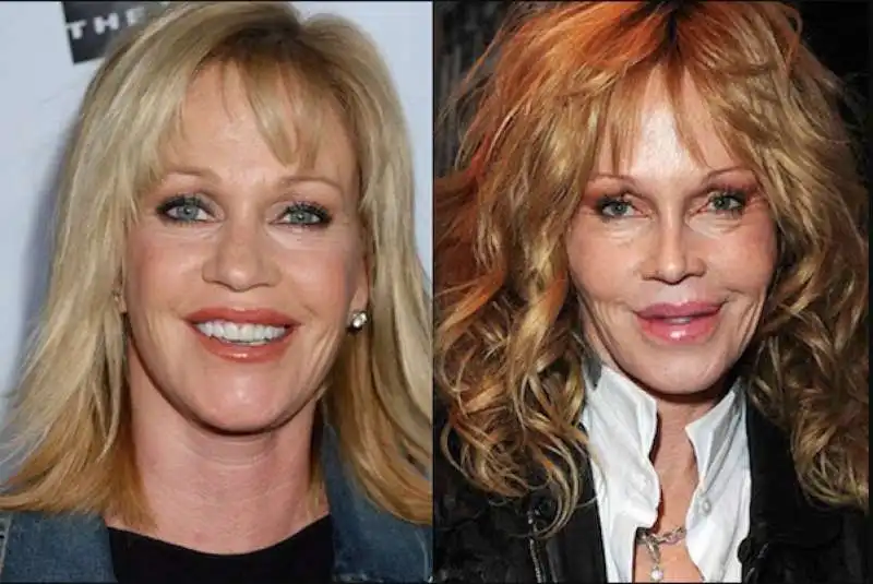 melanie griffith e il botox