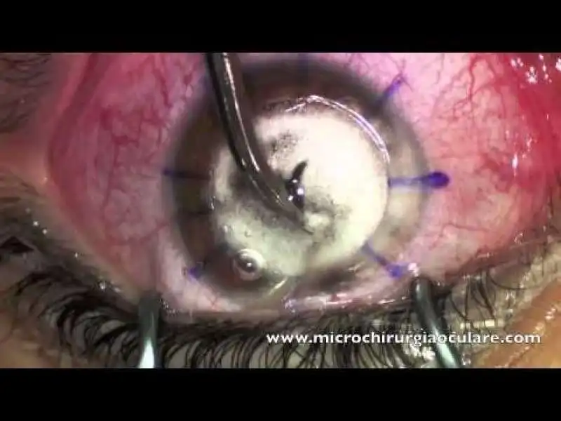 espianto cornea 2