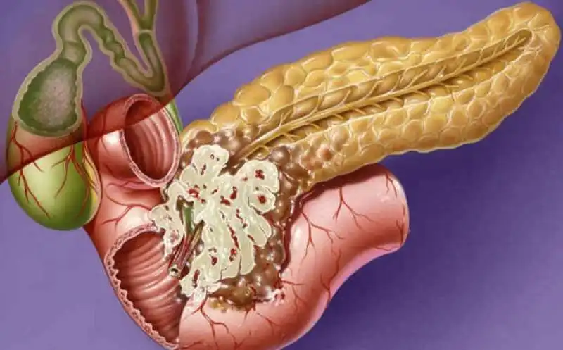 tumore al pancreas 4