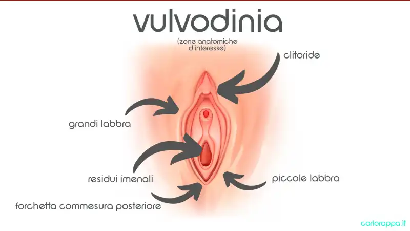 vulvodinia