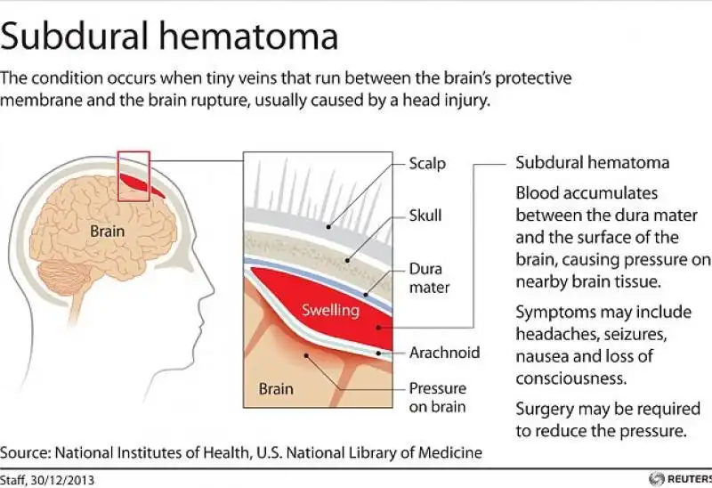 EMATOMA SUBDURALE